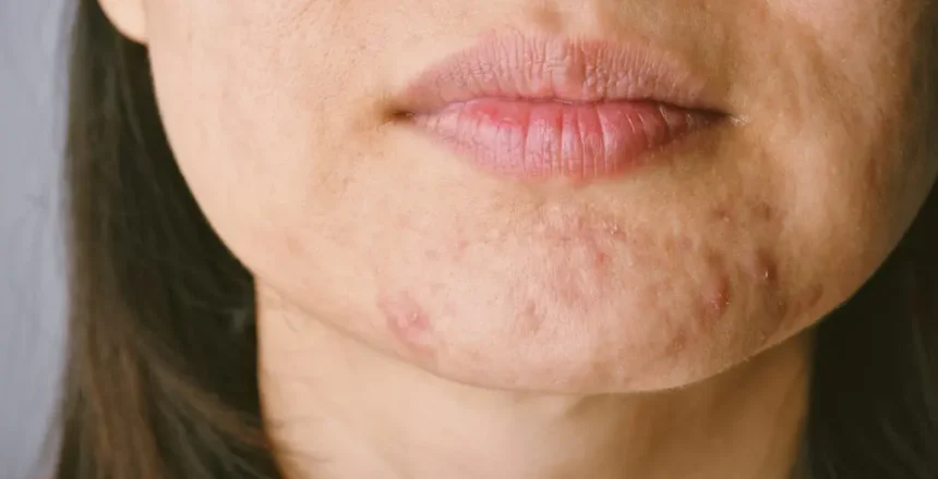 Acne menopausa